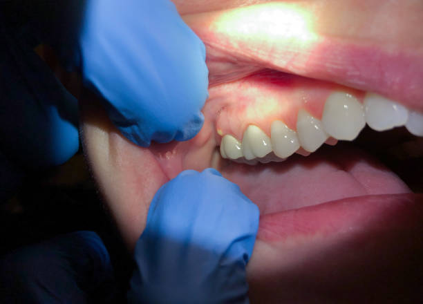 Best Emergency Dental Care for Broken or Chipped Teeth in Wadsworth, IL